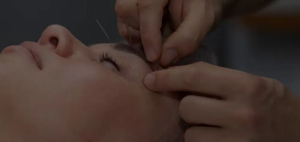 Tratamiento acupuntura paralisis facial en Barcelona Saam Acupuntura