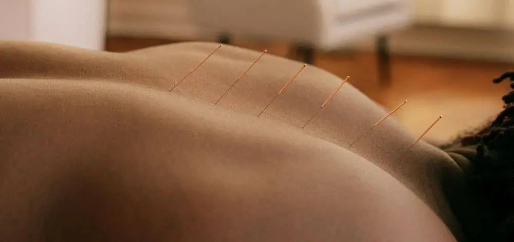 Tratamiento acupuntura punción seca Saam Acupuntura Barcelona